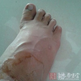 老人脚消肿的最快方法(老人脚消肿的最快方法按摩)