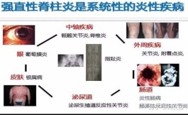 强直性脊柱炎的治疗方法(强直性脊柱炎的治疗方法最佳的运动)