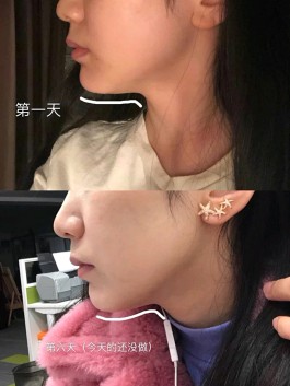 瘦下巴最有效的方法(瘦下巴最有效的方法图片)