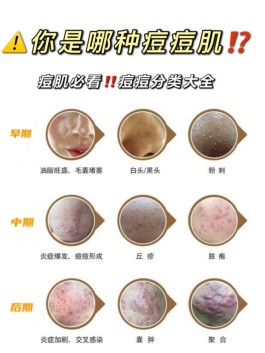 去痘痘的最快方法(去痘痘的最快方法18岁以下药膏)