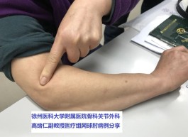 网球肘的治疗方法(网球肘的治疗方法哪种好)
