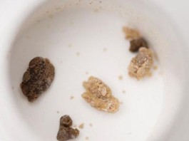 尿结石最好治疗方法(尿结石的最好治疗方法)