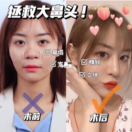 鼻翼缩小的方法(鼻翼缩小的方法不手术)