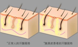 狐臭的治疗方法(狐臭能根治吗最好的方法是什么)