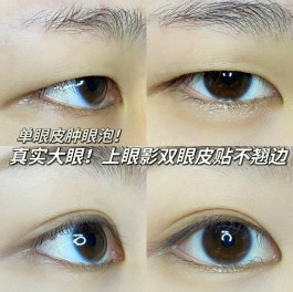 单眼皮变双眼皮方法(双眼皮变成单眼皮怎么恢复)