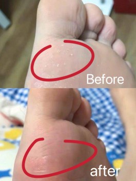治脚气的方法(土霉素治脚气的方法)