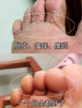 烂脚丫最佳治疗方法(烂脚丫最简单的治疗方法 知乎)