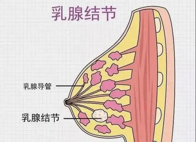 乳腺结节图片 症状图片